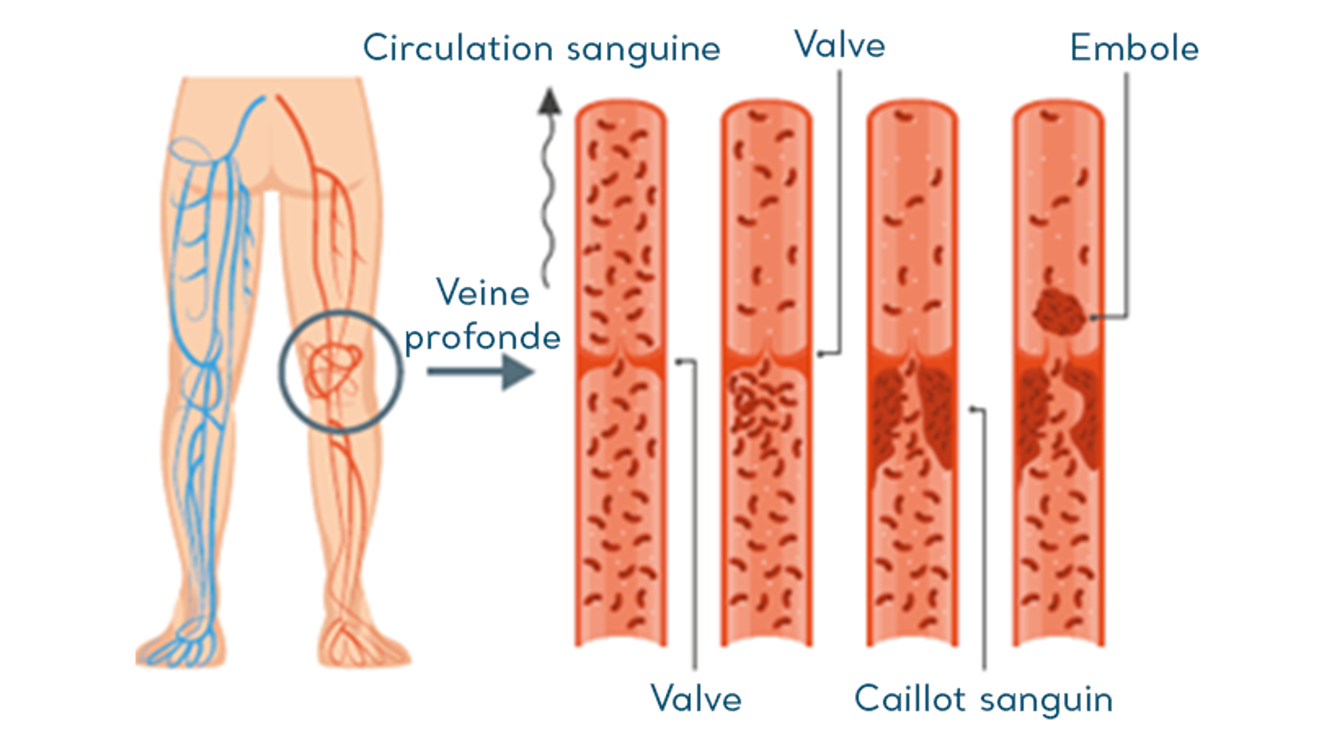Schéma des veines et de la formation des caillots