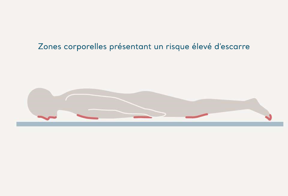 La prévention des escarres pendant la pandémie de la Covid-19: Le positionnement en décubitus ventral