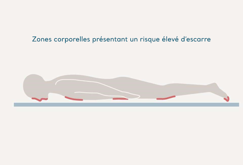 La prévention des escarres pendant la pandémie de la Covid-19: Le positionnement en décubitus ventral